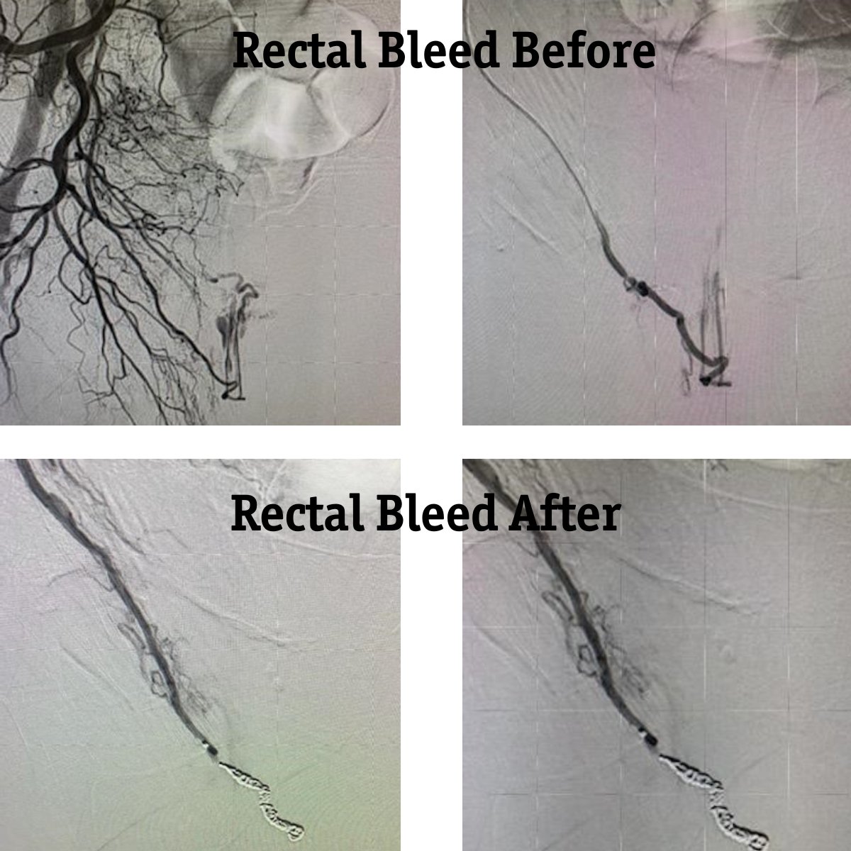 bsc_io_e's tweet photo. Another great #EMBOLDcoils case! Dr. Kokabi used three 2X6 EMBOLD Fibered coils in a #TruSelect Straight 155 cm, w/ radial approach to treat an emergent rectal bleed. Thank you @nimakokabiMD and @EmoryIRad. Looking forward to seeing more EMBOLD cases!
https://t.co/ihdmVpjutg https://t.co/pQtlz3SFrE