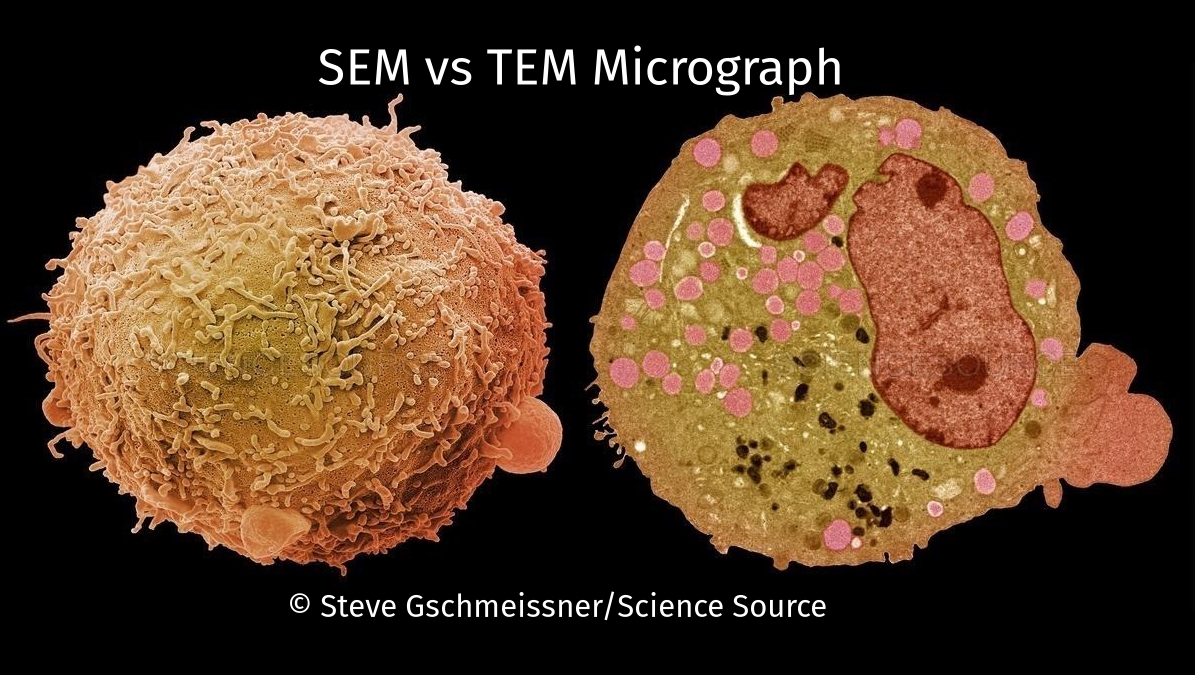 ScienceSource's tweet image. Carcinoma Cell Comparison between a scanning election micrograph (SEM, left) and transmission electron micrograph (TEM, right).  l8r.it/2upf ©Steve Gschmeissner/Science Source
