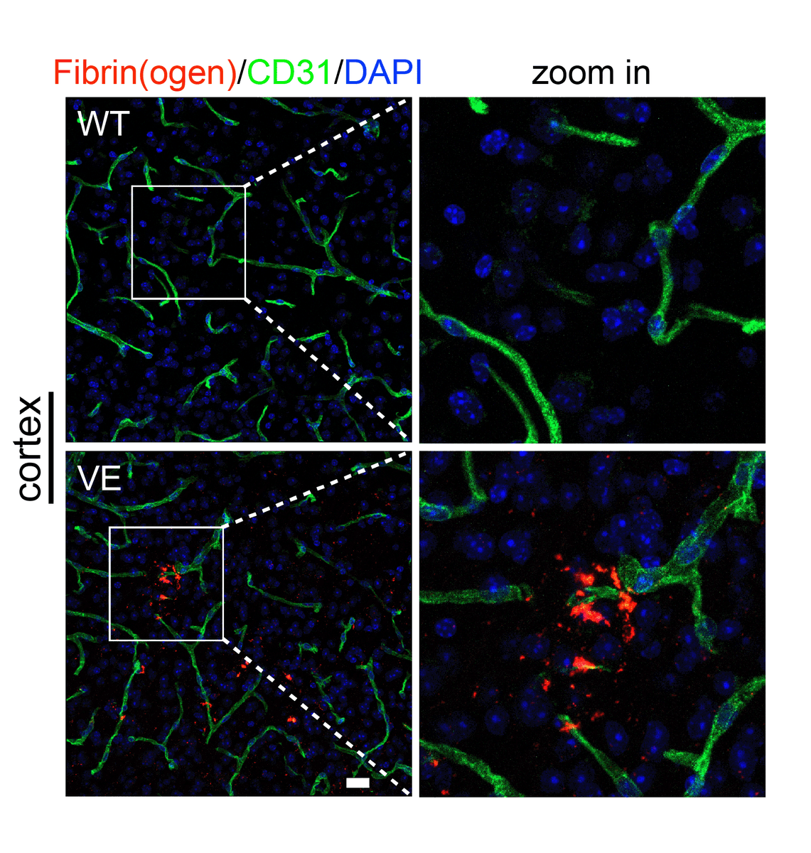 CircRes's tweet photo. Zhou &amp; colleagues identify endothelial #BACE1 as possible biomarker and therapeutic target in hypertension-mediated #CSVD. Learn more at https://t.co/jhp9rwJRAw https://t.co/aFnWEEdCtK