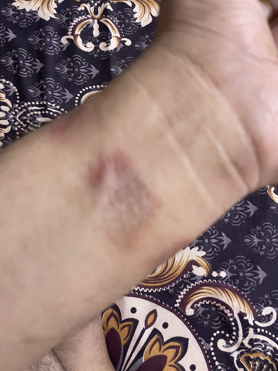 ashishgupta_ind's tweet photo. @AppleSupport I can’t believe I am getting rashes due to my Apple Watch. https://t.co/2SsL1aQHkb