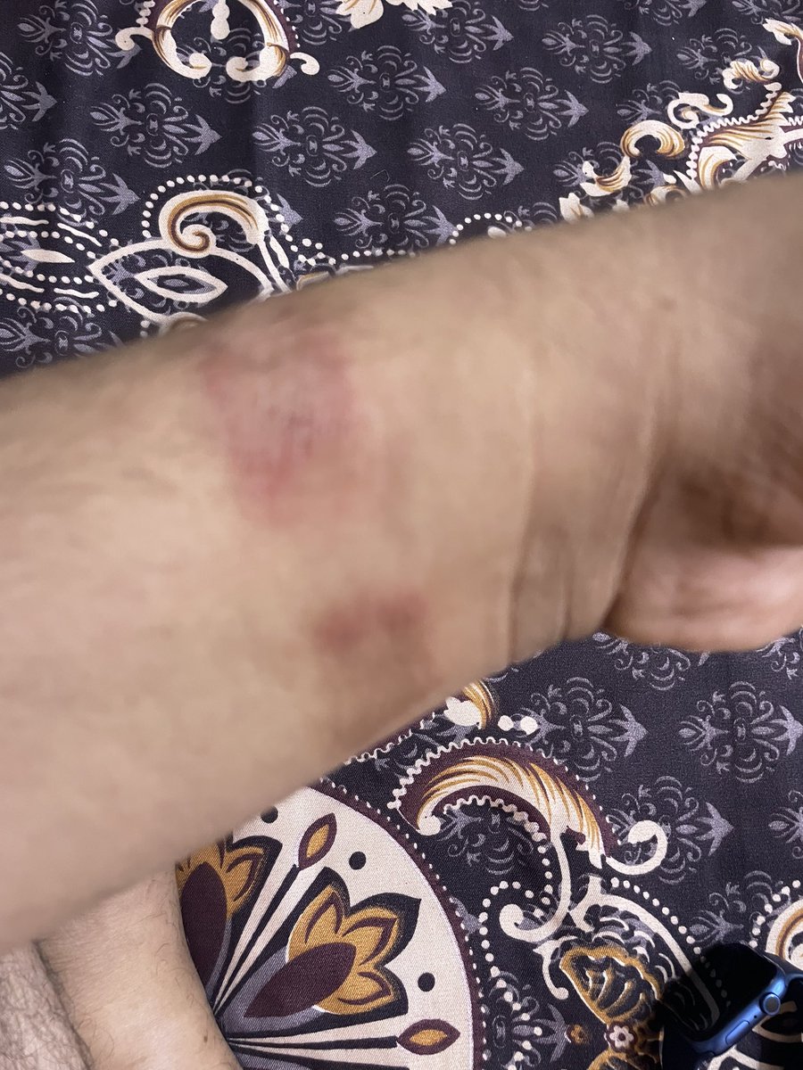ashishgupta_ind's tweet photo. @AppleSupport I can’t believe I am getting rashes due to my Apple Watch. https://t.co/2SsL1aQHkb