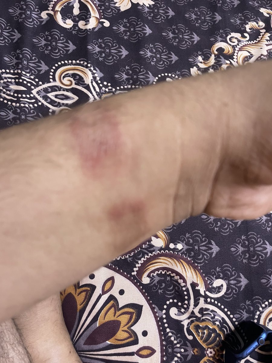 ashishgupta_ind's tweet photo. @AppleSupport I can’t believe I am getting rashes due to my Apple Watch. https://t.co/2SsL1aQHkb