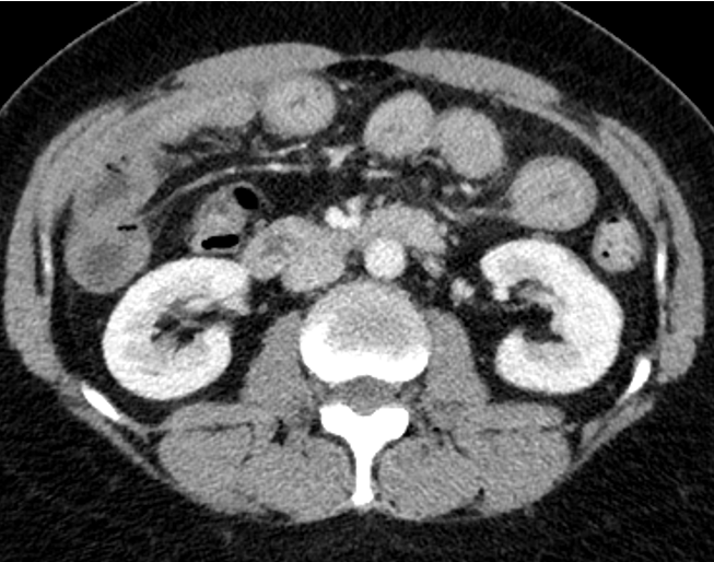 Abdominal pain in patient with history of hypertension and recent medication change.
Diagnosis? GIF's only!
#radres important to be aware of this condition. #FOAMed