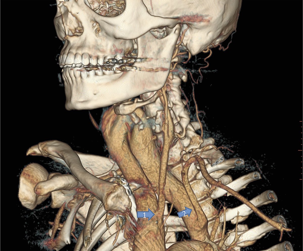 This person’s aortic arch extended into THEIR NECK 🤯

#MedTwitter