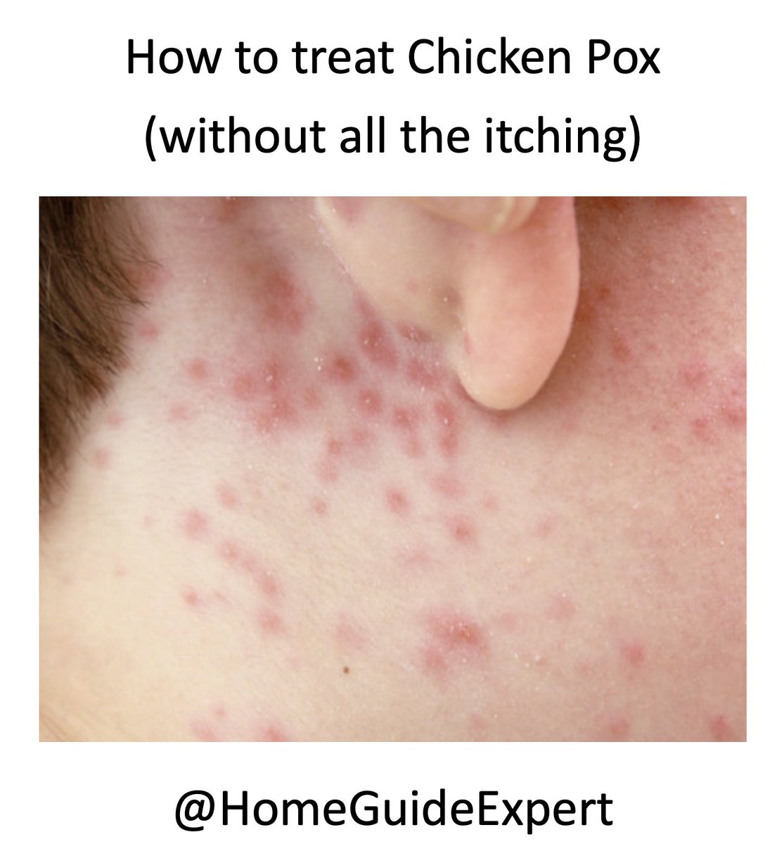 HomeGuideExpert's tweet image. We have had so much online traffic to this guide recently, Chicken Pox is clearly doing the rounds again!
homeguideexpert.com/how-to-treat-c…

#homeguideexpert #ad #af #chickenpox #chickenpoxremedy #homemaderemedies #homemaderemedy #health #welbeing #childhoodmemories #chickenpoxparty