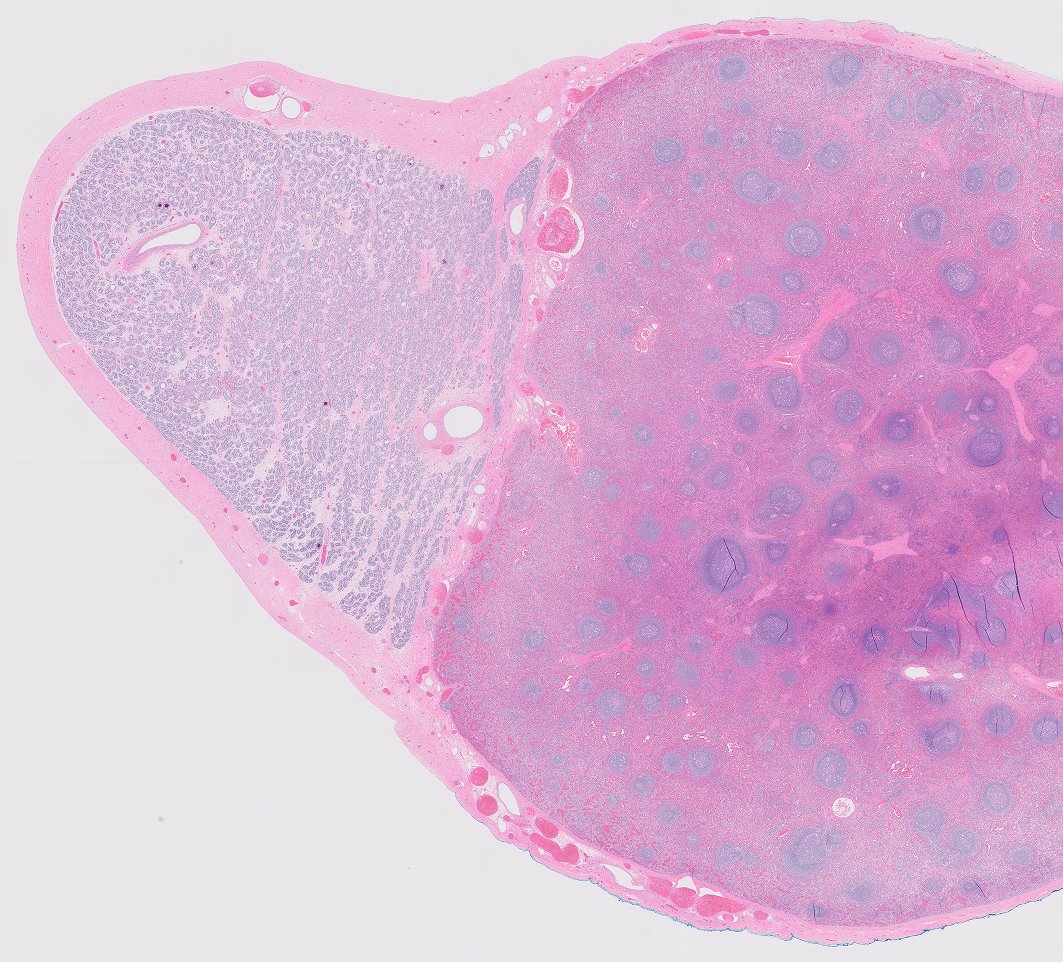 chemily7's tweet photo. almost forgot to update.. it's a rare case of splenogonadal fusion. cut surfaces may have been more helpful but I thought a giveaway; AND our surgeon actually recognized this as spleen intraoperatively which I found quite impressive! but then again, we have great surgeons! :D https://t.co/y3PoRhGKvQ
