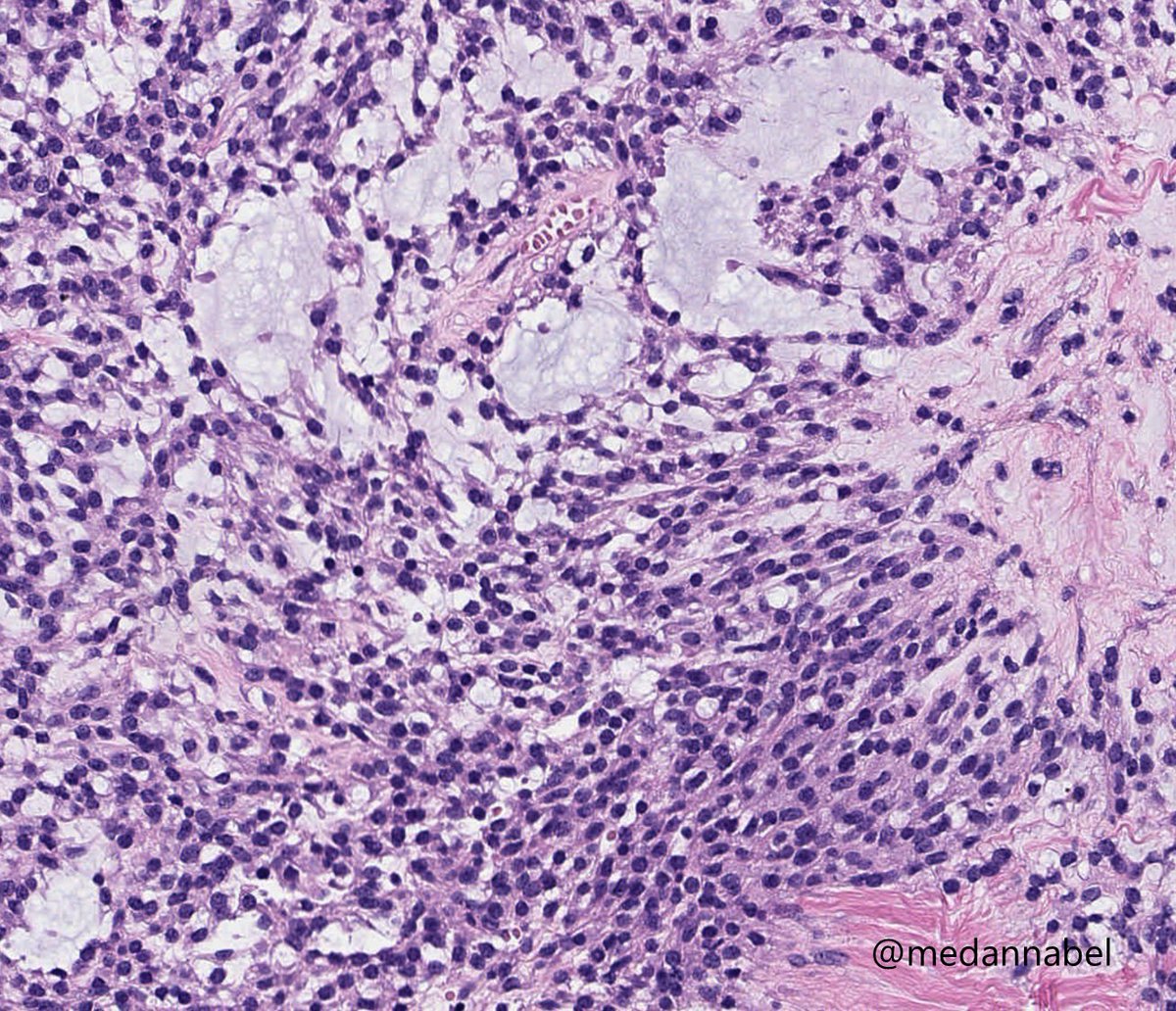 Rare but classic case, ovary, 30's 🙂

#PathTwitter #gynpath