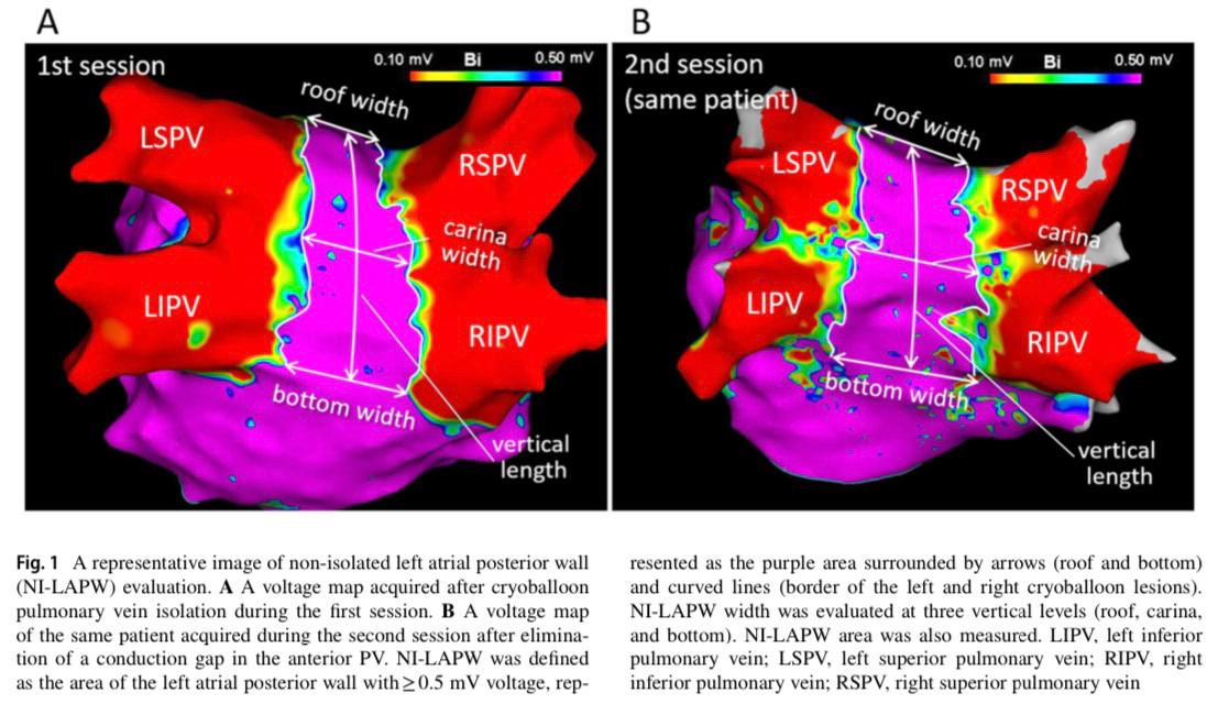 JICE_EP's tweet image. In the latest #freeread of #JICE authors evaluate CB PVI lesions with high-resolution voltage mapping just after PVI (acute phase) and during the second session (chronic phase). Acute CB PVI lesions significantly regressed during the chronic phase ⬇️
rdcu.be/cMETl