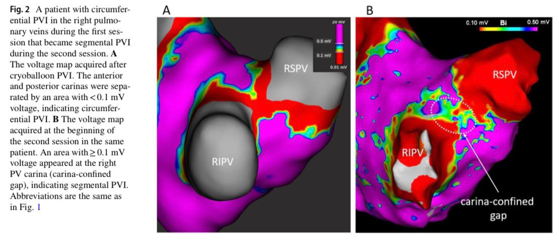 JICE_EP's tweet image. In the latest #freeread of #JICE authors evaluate CB PVI lesions with high-resolution voltage mapping just after PVI (acute phase) and during the second session (chronic phase). Acute CB PVI lesions significantly regressed during the chronic phase ⬇️
rdcu.be/cMETl