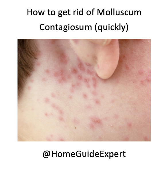 HomeGuideExpert's tweet image. AD How to get rid of Molluscum Contagiosum...quickly.
With over 8,000 people finding our guide,  we offer tips on how to treat it quickly and effectively.
homeguideexpert.com/how-to-get-rid…
#homeguideexpert #children #childrenswellbeing #molluscum #wellness #health #childrenshealth #viruses