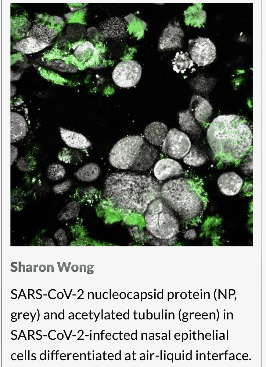 Dr Shafa Waters (@shafawaters) on Twitter photo Check out these #SARS -CoV-2-infected nasal epithelial cells differentiated at air-liquid interface
Vote for Sharon Wong bit.ly/3Fg0bk3
#miCF <a href="/miroastore/">miro astore</a> @
<a href="/LauraFawcett8/">Dr Laura Fawcett</a> <a href="/UNSWmedECAN/">UNSW Medicine & Health ECAN</a> #StemCellfie Contest 2022 Check out these #SARS -CoV-2-infected nasal epithelial cells differentiated at air-liquid interface
Vote for Sharon Wong bit.ly/3Fg0bk3
#miCF <a href="/miroastore/">miro astore</a> @
<a href="/LauraFawcett8/">Dr Laura Fawcett</a> <a href="/UNSWmedECAN/">UNSW Medicine & Health ECAN</a> #StemCellfie Contest 2022