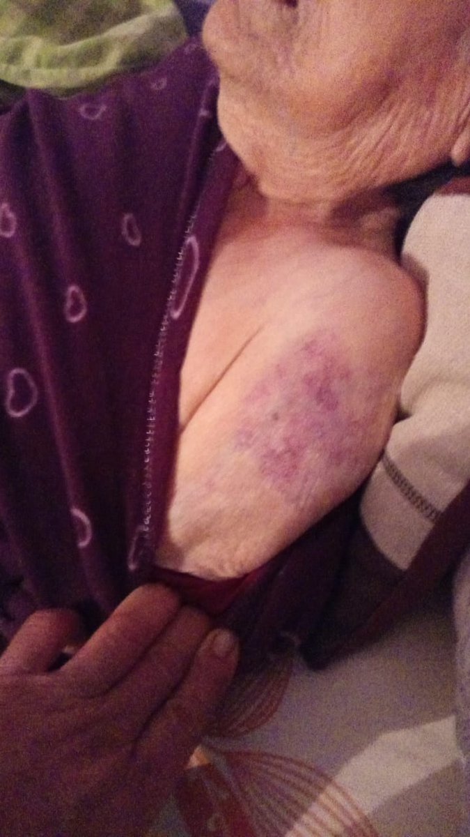 LaCarodeValpo's tweet photo. @senamavalpo @SaludSsrv Mi abuelita de 94 años ingresó el 21/03 con su capacidad mental 100% operativa al Hogar ROSA KRAYER. Ayer la fuimos a "rescatar" pk estaba deteriorada, alucinando, dopada casi sin hablar más un hematoma en su bracito que nadie nos informó.Basta de maltrato https://t.co/h5IzLMRxIt
