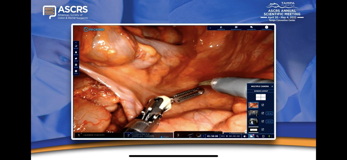 More T-burg for @AjthorsenL please! Live surgery happening now! Come join us in person or live stream. #ascrs22 #rectopexy @ASCRS_1 #livesurgery