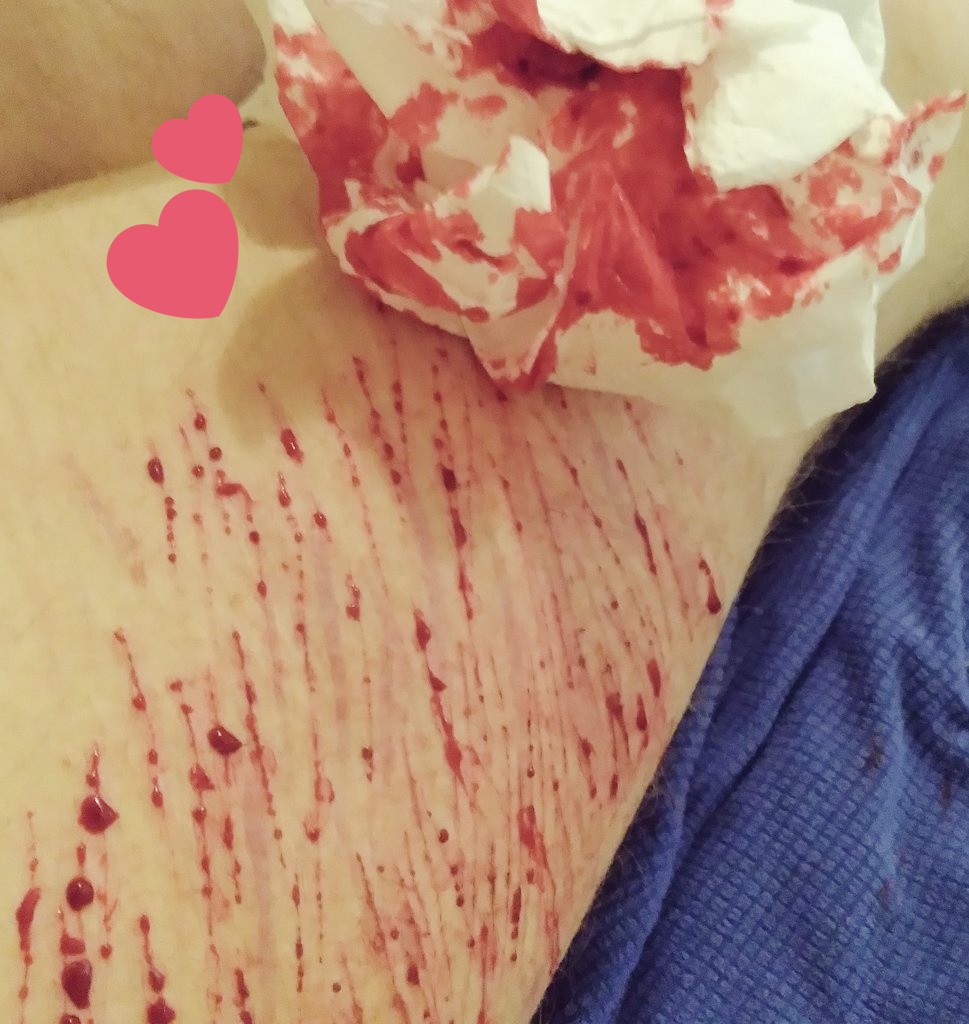 AsmodeusBleeds's tweet photo. I'm so fucking pathetic. So upset and yet this is all I have the energy to pull. Bs. 
shtwt ouchietwt catscratchtwt

!! FAKE SFX MAKEUP - LOOKS VERY AWESOME YALL !! https://t.co/QdC8yaC0Ou