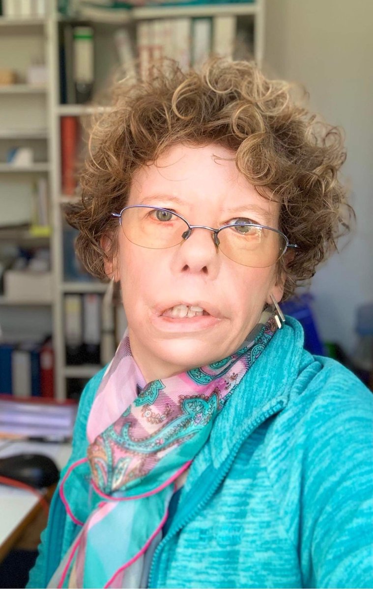 MoebiusSyndrome's tweet photo. Continuing with our Limitless series, the Moebius Syndrome Foundation would like to introduce the community to Zoe A. Cross.
Read Zoe's story here https://t.co/S2UwwTaSam and find a link to her TEDx talk!
What makes YOU Limitless?
#MSFLimitless #moebiussyndrome https://t.co/kh2QV5X0pn