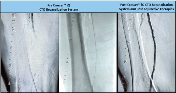 RobRighi's tweet photo. Dr. Mayeda crossed a 12cm CTO using #CrosseriQ catheter and observed a 1 min activation time. Great case! #CrossThisFast
For use in peripheral artery CTOs; Not for use in carotid arteries. Safety info: https://t.co/IGoWw3z4zP https://t.co/Vn7OnCuvAf