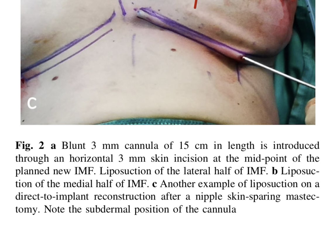Aesthetic Plastic Surgery Journal (@aps_journal) on Twitter photo Defining the Inframammary Fold by Liposuction: An Essential Tool in Aesthetic Shaping of the Reconstructed Breast.
A study from 🇮🇹
See full text below:👇
link.springer.com/content/pdf/10…
<a href="/isapsofficial/">isapsplasticsurgeons</a> #isaps Defining the Inframammary Fold by Liposuction: An Essential Tool in Aesthetic Shaping of the Reconstructed Breast.
A study from 🇮🇹
See full text below:👇
link.springer.com/content/pdf/10…
<a href="/isapsofficial/">isapsplasticsurgeons</a> #isaps