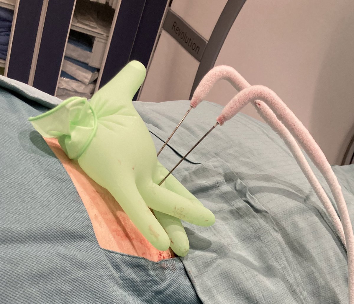 Cryoablation of 2 cm RCC using 2 probes and hydrodissection away from the spleen. Nice ablation zone on final CT. Hopeful for a lasting result! <a href="/NYGH_News/">North York General</a> <a href="/CAIRweb/">Canadian Association for Interventional Radiology</a> <a href="/SIR_ECS/">SIR ECS</a> <a href="/RMargau/">Ryan Margau</a> <a href="/Katie70842020/">Katie</a> posted with patient permission