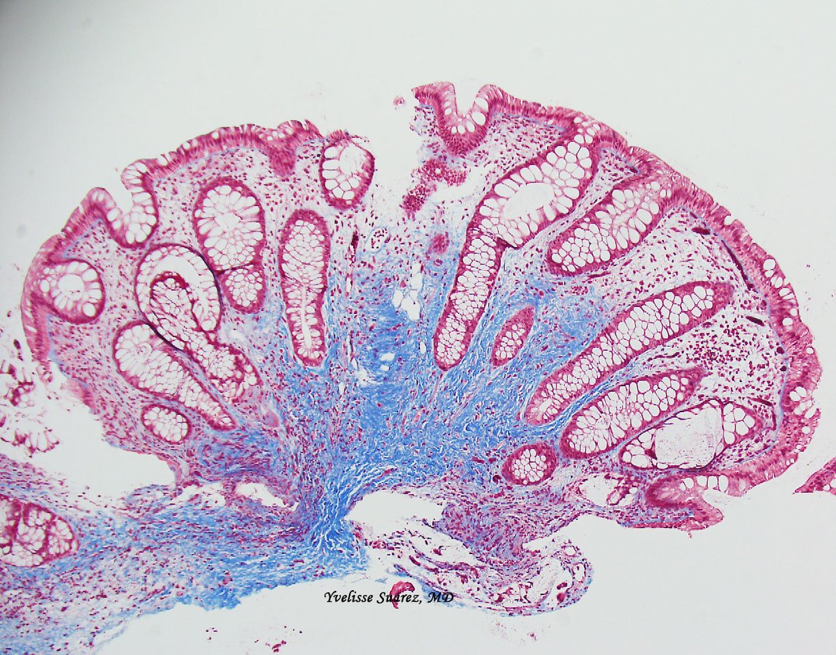 Dr_Y_Suarez's tweet photo. Little polyp in a young man with PTEN mutation.
#GIPath #colonpolyp @NYUGSOMpathres https://t.co/aDqpLmpY5N