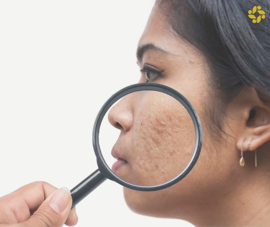 SkinBodyRenewal's tweet photo. A discolouration of the skin known as PIH (Post Inflammatory Hyperpigmentation) are dark marks left behind on the skin after the pimple has dried https://t.co/6hJSTiPdPw
#SkinRenewalSA  #skin #skincare #acne #AcneScars #PIH #FitzpatrickScale #scars #scarring #skintexture https://t.co/8nhhsQ76CX