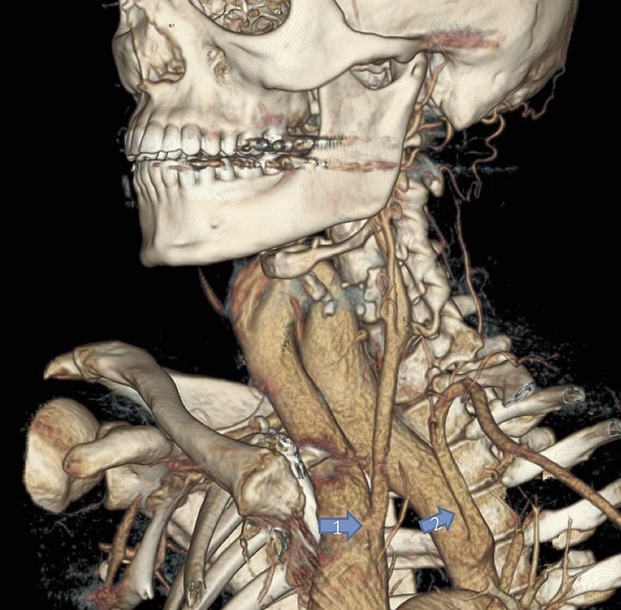 You start an acdf and you find this. What’s next step?