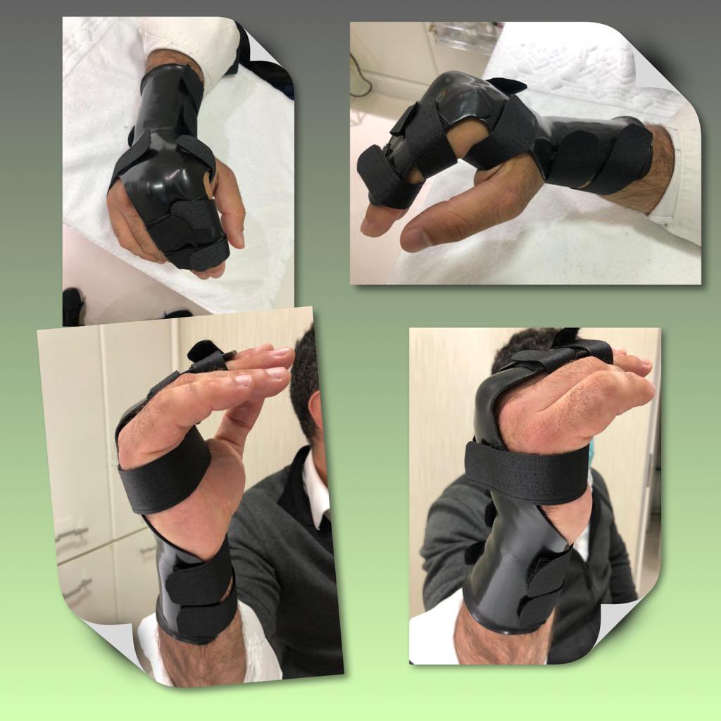 A Fratura do Boxer (Boxeador ou pugilista) leva esse nome devido a maior parte delas ocorrerem após um soco em uma superfície dura como uma parede, porta, mesa, entre outros