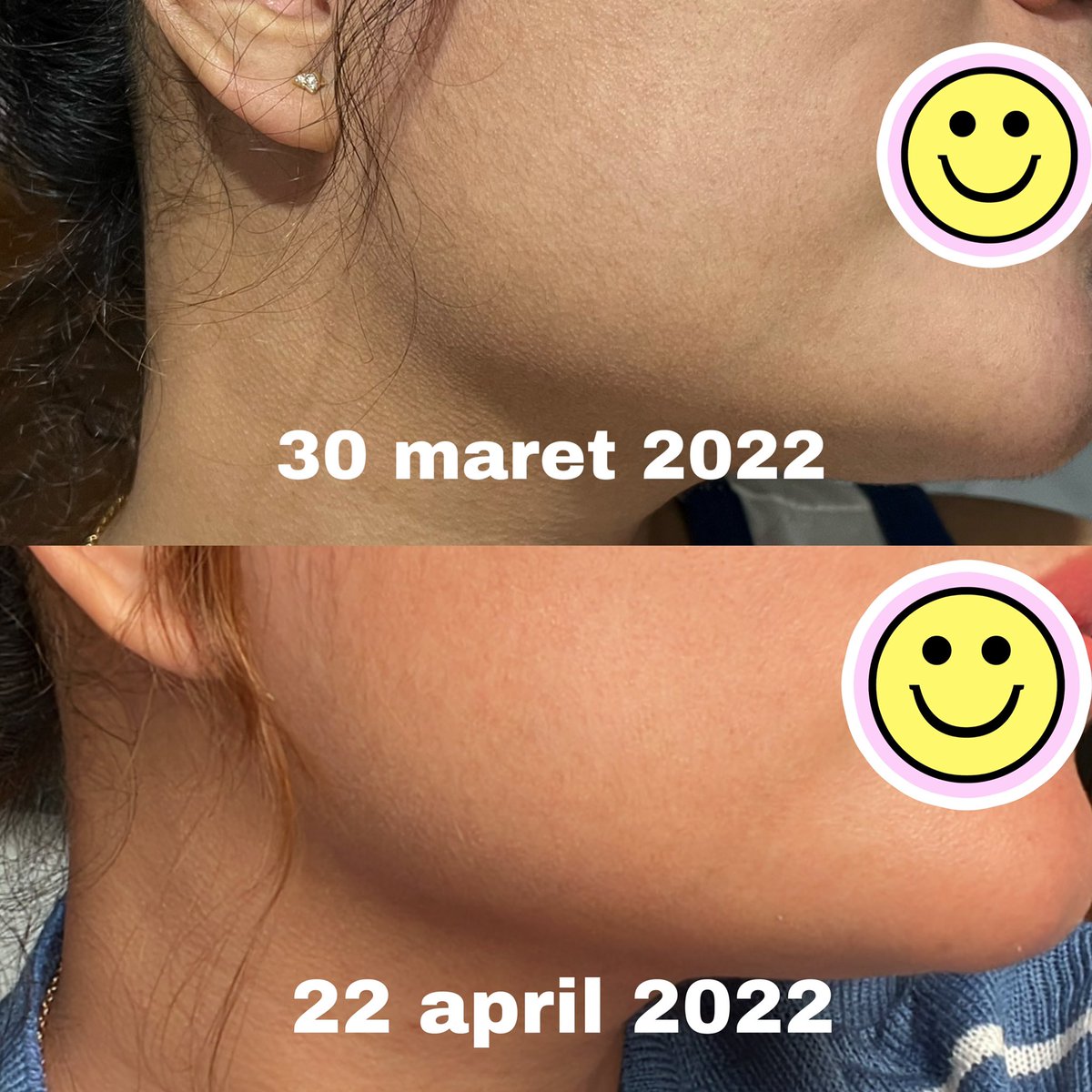 beloveddsummer's tweet photo. ‼️ SAY GOOD BYE TO DULL SKIN & DAMAGED SKIN BARRIER ‼️
Aku mau #racuninskincare nih guys, kali ini serum berdasarkan pemakaian pribadi kurang lebih 1 bulan
#SYABatch1 #PakaiSOMETHINC #Odriviu https://t.co/AdxIWC5y7z