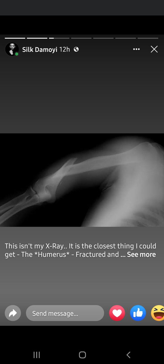 Azzy_EC's tweet photo. PLEASE HELP: @MrSilk_D recently got his big break in radio broadcasts by joining SABC @trufm 

A week later he got involved in a terrible car accident that left him terribly injured. Now we kindly ask for donations for his operation, all details on the 4th frame. PLEASE HELP.!!🙏🏽 https://t.co/sHTz5h6CVP