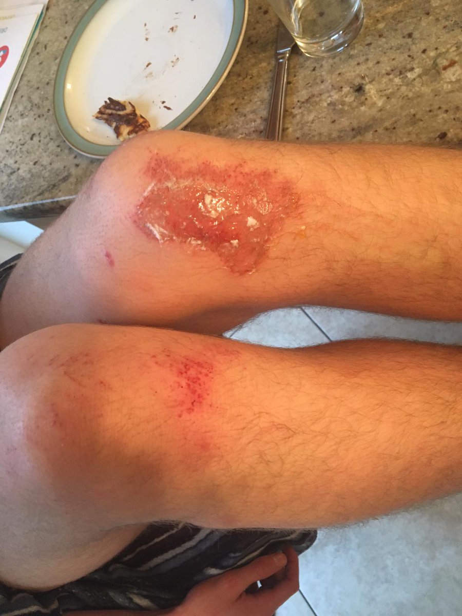 Gmeister111's tweet photo. @andymcgeady 17 Yr old knee after Musgrave Park schools match, pitch not watered.Burn dressings and antibiotics  required https://t.co/AK4lZ65FKy