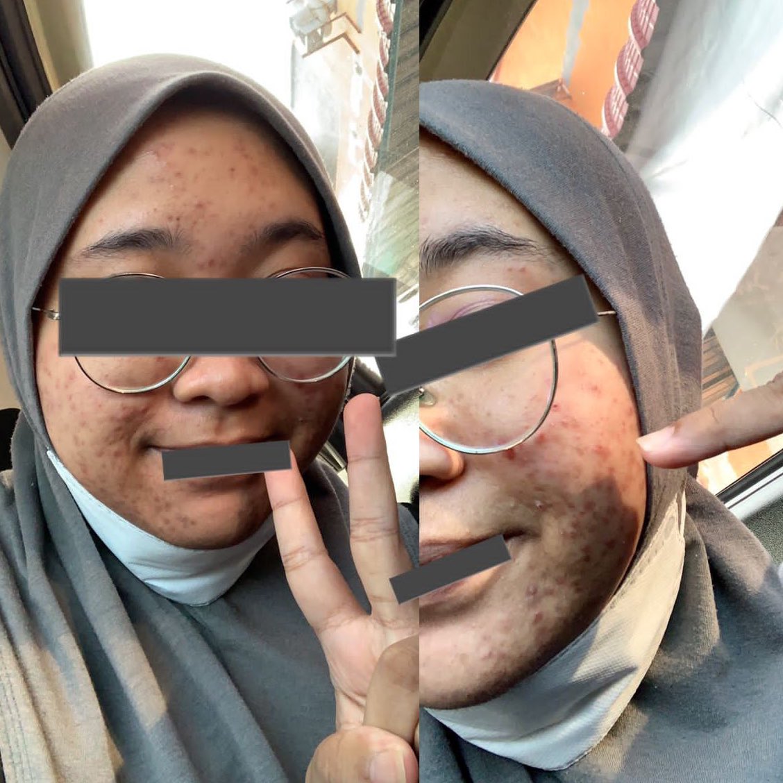 mieracart's tweet photo. Penat dah cari skincare yang boleh treat acne prone skin tapi banyak tak effective!!

Sekali terbeli and terpakai serum ni omg clear skinnn worth the moneyyy😭💯 https://t.co/30vbSOmXuR
