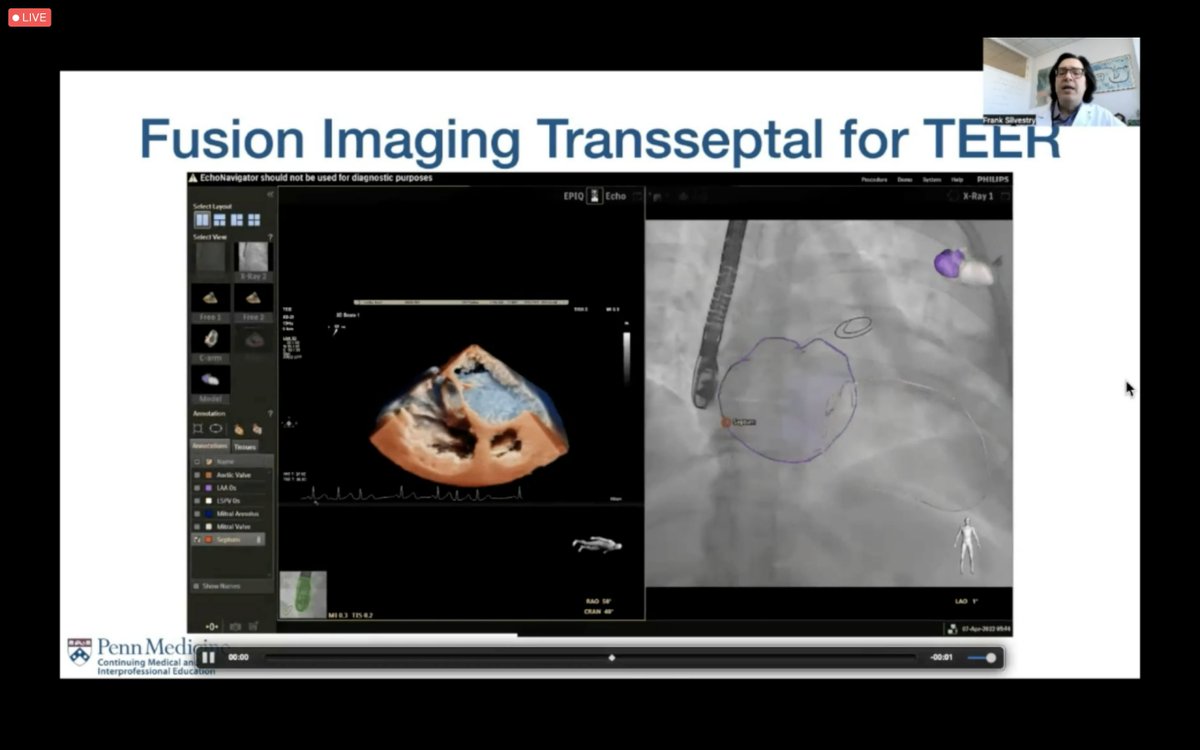 tiffchenMD's tweet photo. Dazzling ✨ talk at #PennValve symposium by #echofirst #iecho & #SHDimaging extraordinaire @FSilvestryMD on new #cvImaging technology📸🛠️ in #iecho including fusion 🔊🩻 & #3D ICE 🧊 for #mitraclip TEER, #LAAO, & #PVL closure - excellent procedural #ACCimaging is key 🔑! https://t.co/3UJ7Ie7TTb