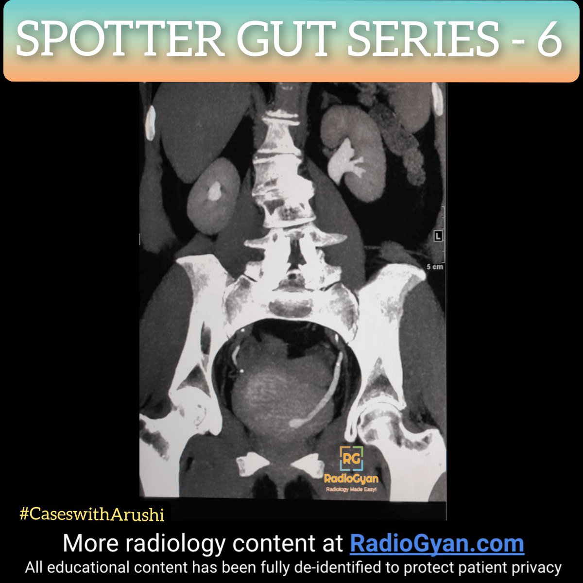 TeamRadioGyan's tweet photo. #SaturdaySpotter
⠀
Welcoming you with another fun spotter for this week.
⠀
Please leave your answers in the comments below.
⠀
Hosted by #teamgyan member Dr. Arushi Gupta. Follow her on @radiologywithdrarushi for more.
⠀⠀
#ct #coronal #gut
#FOAMrad #radres #radiology #radiolo https://t.co/hktdXhDG2r