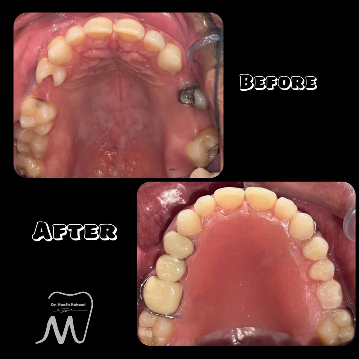 iM3_7K's tweet photo. Graduation case 🎓🤗🦷
|
|
Comprehensive case include:
Re RCT + PFM bridge #25+ PFM Crowns #46,36 + E-Max crown #45+
Transitional RPD #14,15,16.✨
#dentistry #dentist #kku_dent https://t.co/HdkGiZIkkC