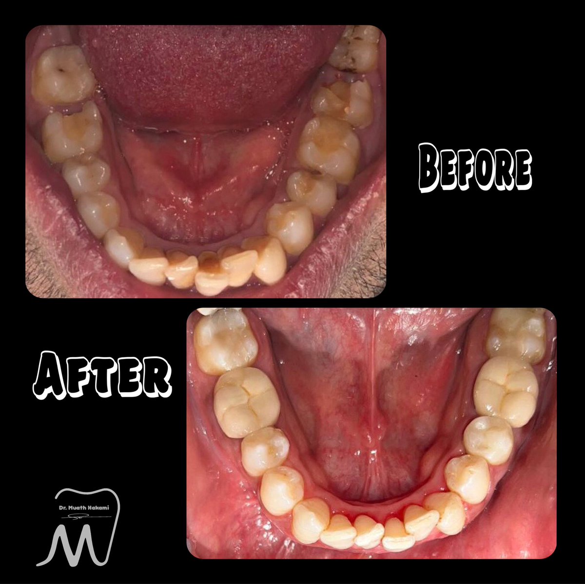 iM3_7K's tweet photo. Graduation case 🎓🤗🦷
|
|
Comprehensive case include:
Re RCT + PFM bridge #25+ PFM Crowns #46,36 + E-Max crown #45+
Transitional RPD #14,15,16.✨
#dentistry #dentist #kku_dent https://t.co/HdkGiZIkkC