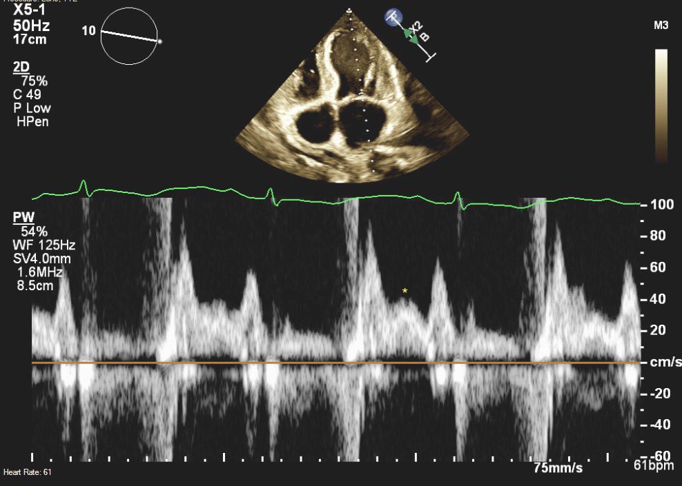 Deya_AlkhatibMD's tweet image. A short 🧵 on L wave (PW of MV inflow) following the quiz yesterday. 
@JaeKOh2 @argulian @NMerke @fazalabul @DrRajeshG1 @AsyiqRaffali @MDMankad @MahamadAboESoud @LucySafi @leilii @VLSorrellImages @ASE360 @danilorenzatti #echofirst #Echo #CardioTwitter #MedTwitter (see below👇)