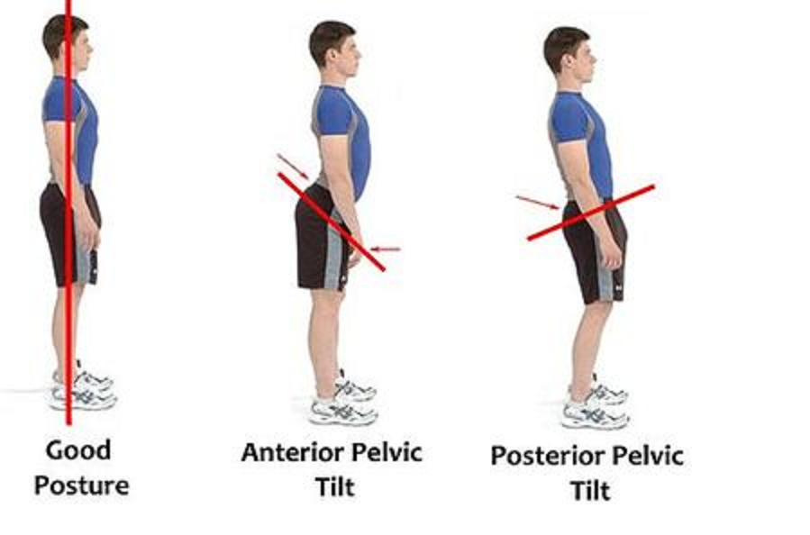 drdozellodc's tweet photo. Lower Cross Syndrome
Dr Donald A Ozello DC of Championship Chiropractic
#Vegas #Chiropractor #Chiropractic #sportsmedicine #Posture #Posturalcorrection #lowercrosssyndrome #Lowercrossedsyndrome #PelvicTilt https://t.co/zGY5ltMoJn https://t.co/q613HwifUT