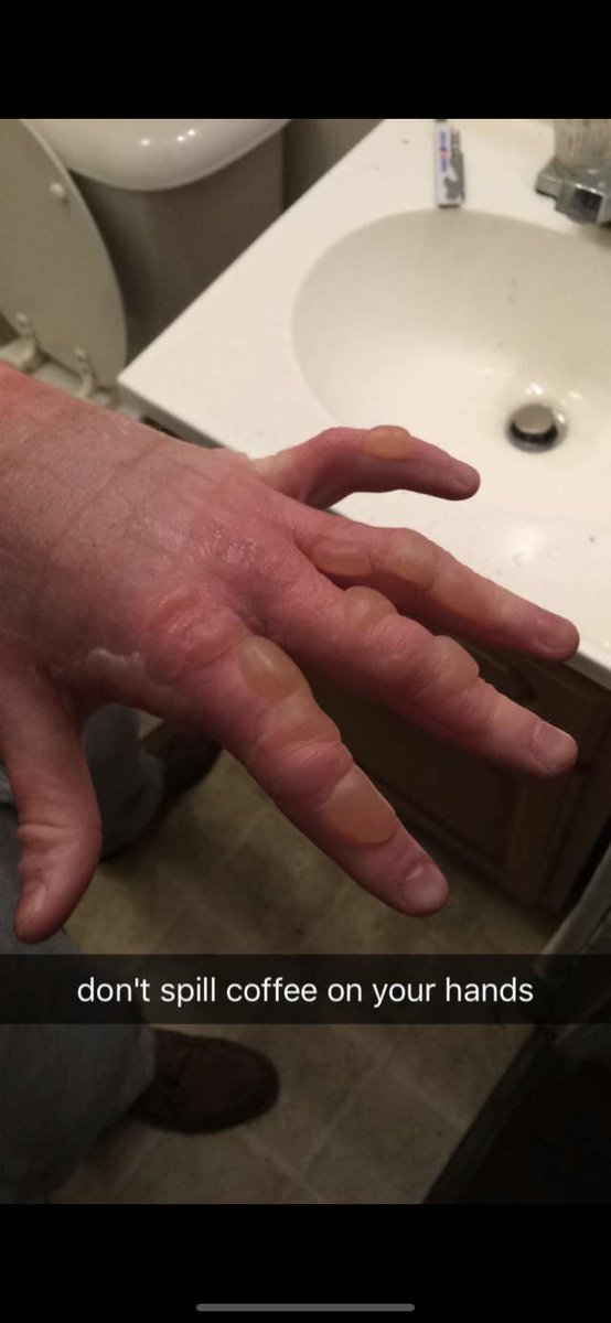 SBarrett16's tweet photo. @SnakeRyan69 On a scale of 1 - fruit snack sized blisters how bad is it? https://t.co/Jfrxf66MEc