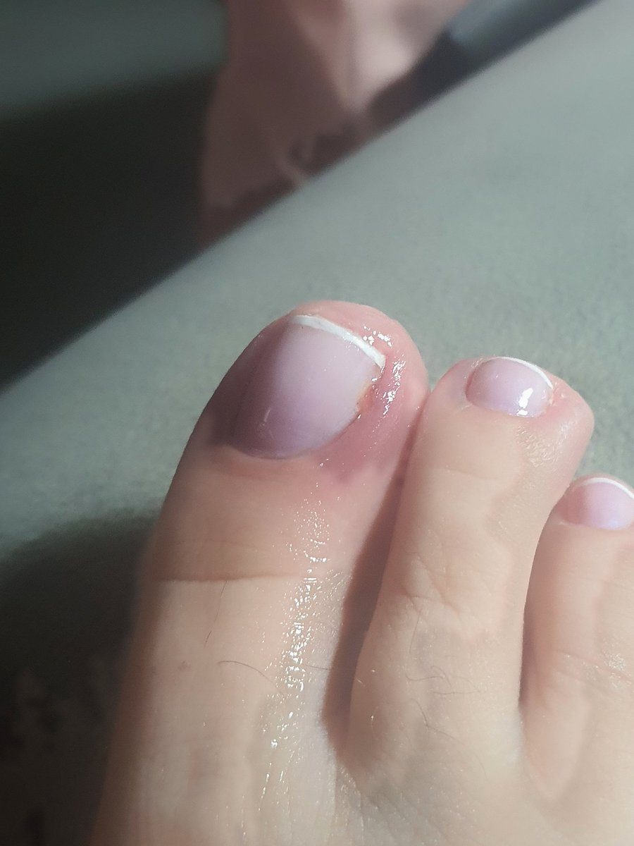 MichellePortes2's tweet photo. Eu tô morrendo de dor no meu dedo!!A manicure fez uma cirurgia nele hj em vez de só tirar cutícula!
#toputa https://t.co/Svc2UJqFwY