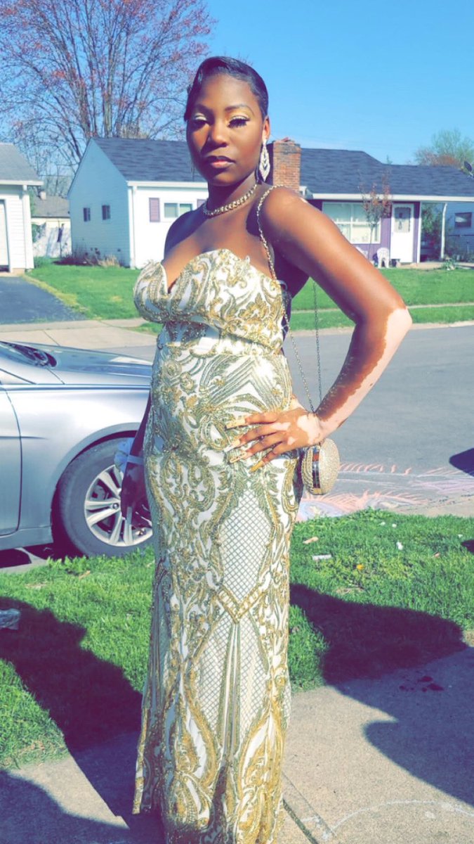 abject_reality's tweet photo. My baby looked so gorgeous today 😍🥰#vitiligoawareness https://t.co/hVozonY1Qh