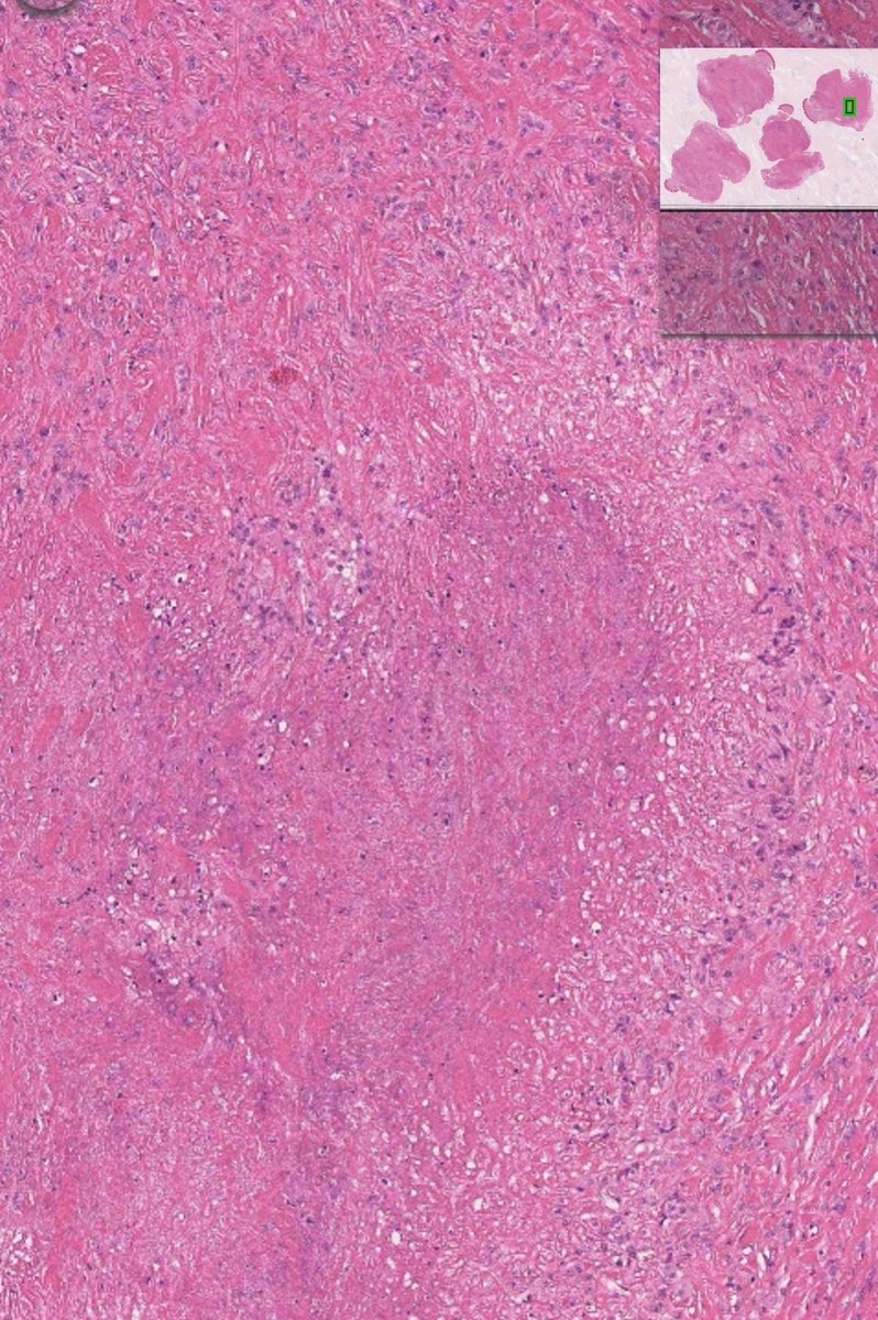 amnabruno's tweet image. 📌Rheumatoid nodule 
Fibrin deposition &amp;amp; necrobiosis is often seen in center of nodule surrounded by well developed palisading of histiocytes, granulation tissue, lymphs, plasma cells, eosinophils, variable giant cells, fibrosis, occ giant cells
#TwitterPath #MedTwitter