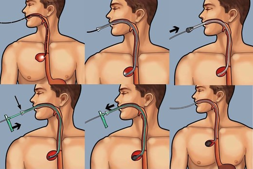 BjsOpen's tweet photo. Analysis of #esosponge registry for oesophageal perforation &amp; leak:
102 patients🧑‍🤝‍🧑
Reoperation rate 25%
Closure rate 91%
Mortality 6%
Interesting data from an evolving practive

https://t.co/cSXB4kIpvH

#SoMe4Surgery 
@asgbi @SEIQuirurgica https://t.co/gboKwDXqyD