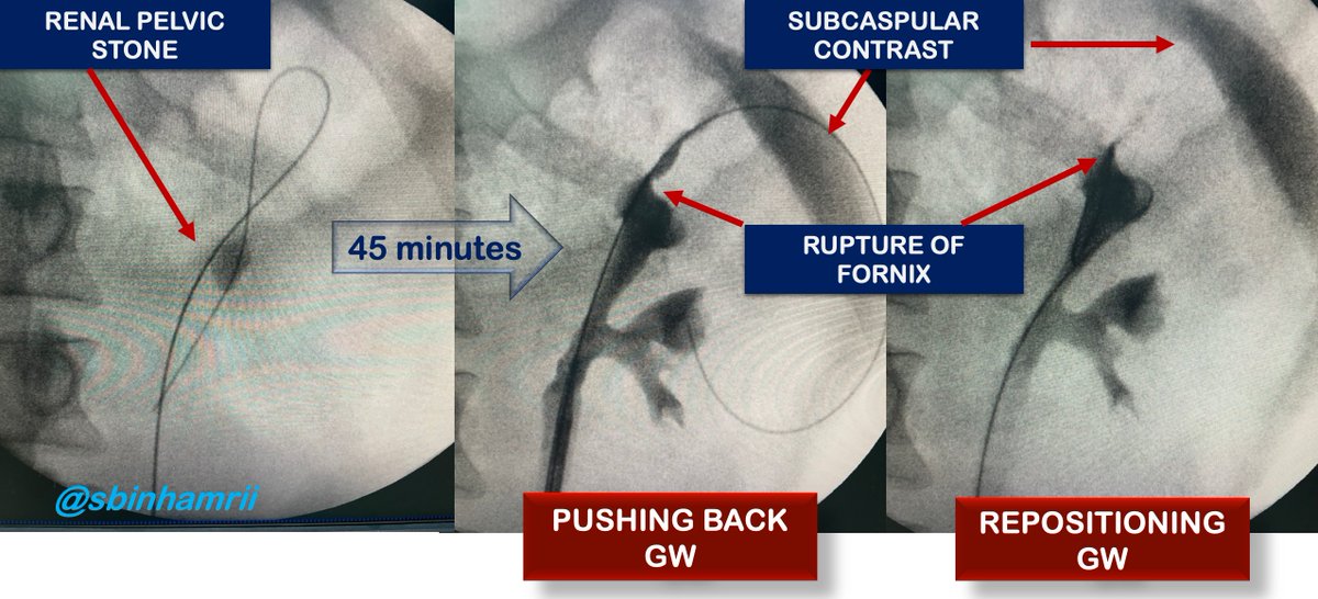 sbinhamrii's tweet photo. ⭕️Started #RIRS However at the End noticed that GW took another way (SUBCAPSULAR)
⭕️Creation of High IRP environment caused:
1. Rupture of Fornix
2. GW perferoation
3. Subcapsular Extravasation Maybe with long OT Hematoma
🚩THM: Inject contrast every 20 min to see whats going on https://t.co/8MwzL34Mhf