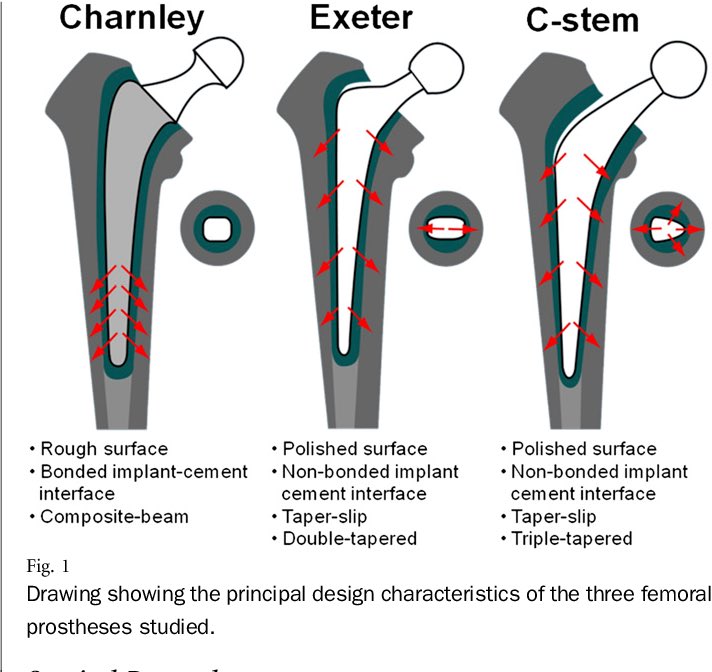 Ignatius Liew (@ignatiusliew) on Twitter photo #FRCSTrandOrthdiagrams what’s your choice of hip stem for frcs? <a href="/JointRegistry/">NJR</a> <a href="/ExeterHipUnit/">Exeter Hip Unit</a> <a href="/BritishHip/">British Hip Society</a> force closed loaded taper polished controlled subsidence strongest in compression, hoop tension, reduce stress shielding due to Wolff’s law #FRCSTrandOrthdiagrams what’s your choice of hip stem for frcs? <a href="/JointRegistry/">NJR</a> <a href="/ExeterHipUnit/">Exeter Hip Unit</a> <a href="/BritishHip/">British Hip Society</a> force closed loaded taper polished controlled subsidence strongest in compression, hoop tension, reduce stress shielding due to Wolff’s law