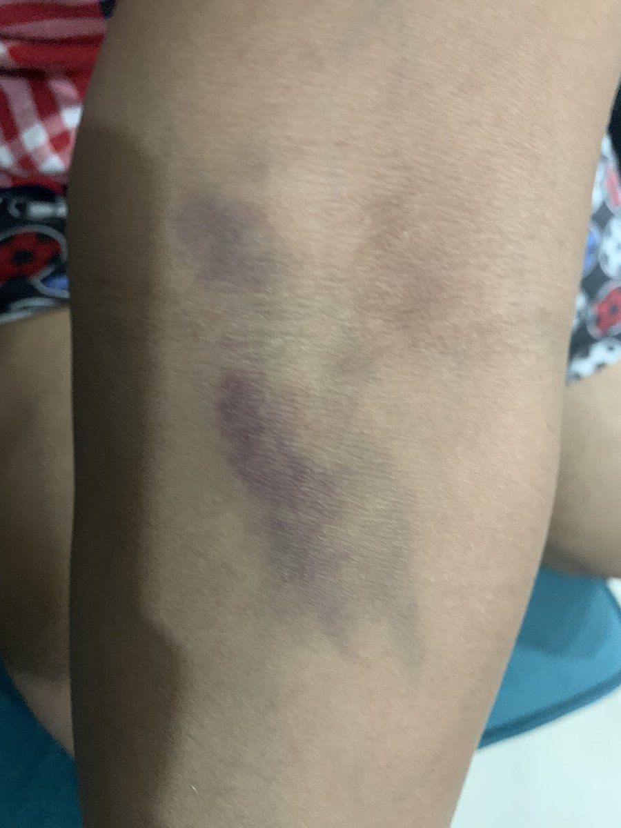 rohitkietcs's tweet photo. @apollodiag This is how your representative had taken blood for the blood test…seriously no professionalism .. https://t.co/KLYG5tawBl