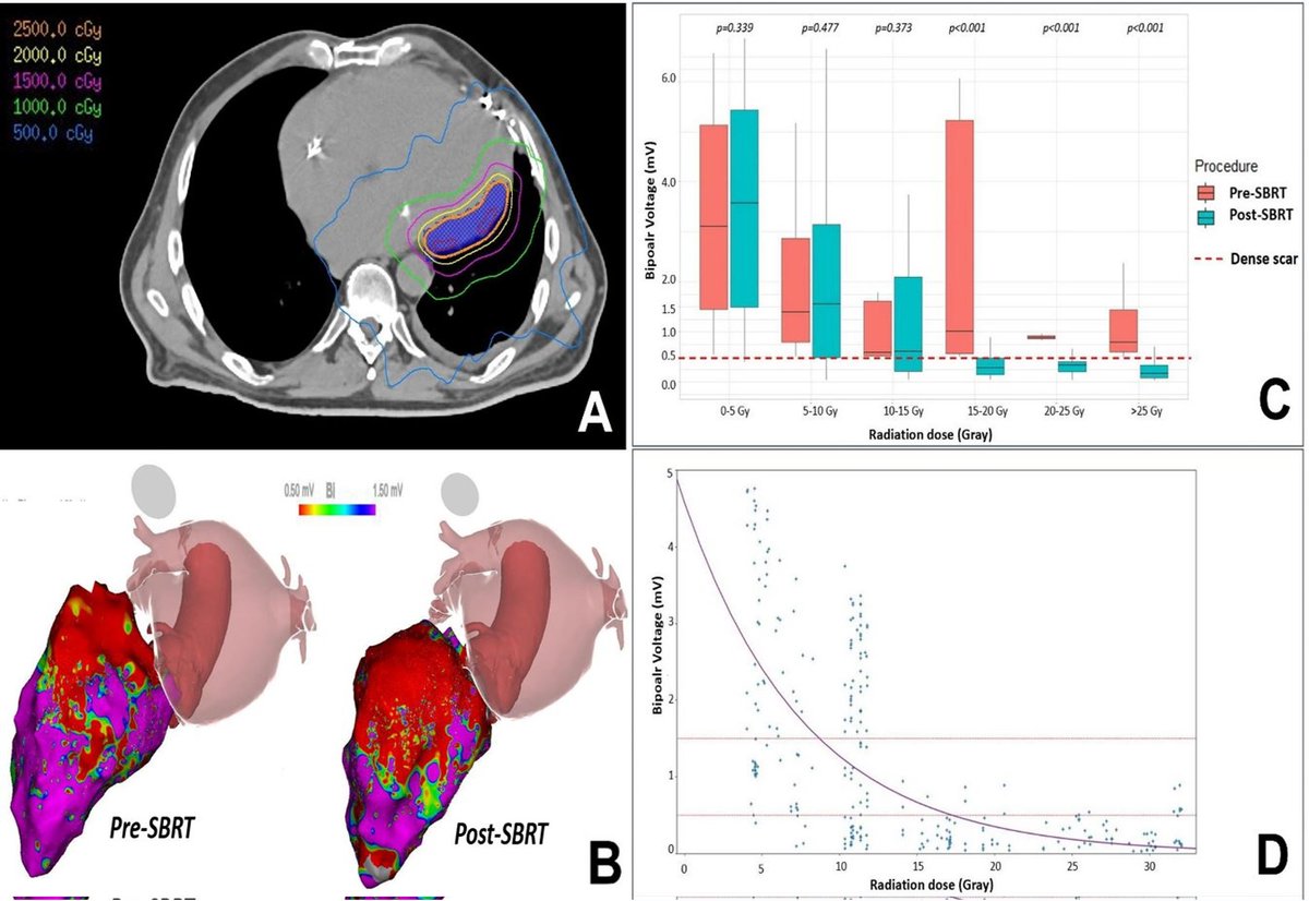 ⚡Are 25 Gy necessary for cardiac SBRT? Check out our latest Research Letter published by @KarimBenali42 et al in @hrs_journal demonstrating an ablative effect starting above 💥15 Gy💥
⬇️Less is possibly 🔀enough
#EPeeps #RadiateVT
heartrhythmjournal.com/article/S1547-…