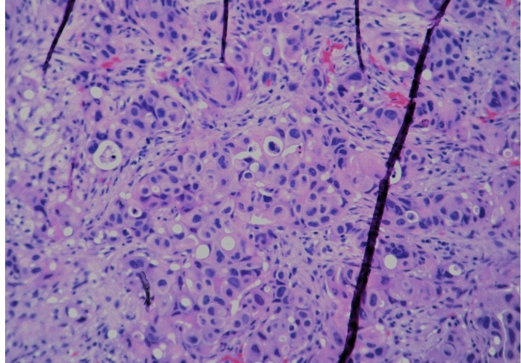 amnabruno's tweet image. 📌Apocrine CA, breast
➡️Tumor cells have distinct cell margins, abundant acidophilic cytoplasm with eosinophilic granules, central to eccentric nuclei with prominent nucleoli
➡️Similar/ slightly better prognosis as inv ductal ca
➡️Mostly triple negative
#TwitterPath #MedTwitter