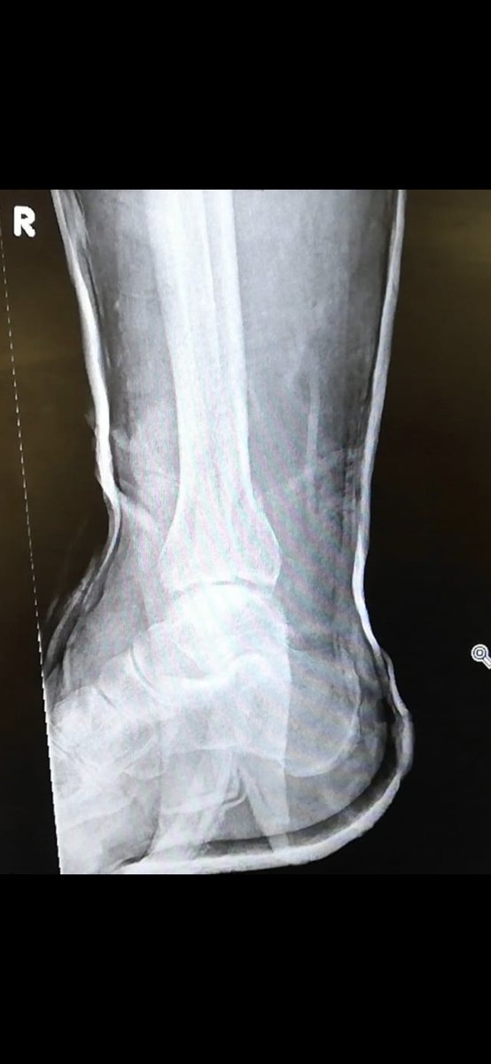 VHK_FifeEM's tweet photo. It was a good Friday.. @ScotGEMStories med student relocated a dislocated shoulder, then a JCF did this awesome reduction of a nasty trimall #/dislocation @doc_price #FifeforLife #EDrocks https://t.co/lBDmQTFQNa