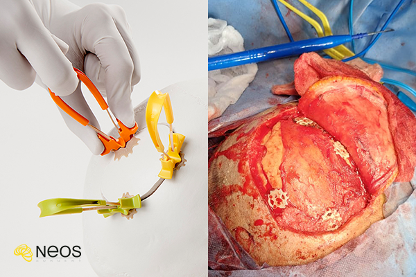 NEOS Surgery tweet media