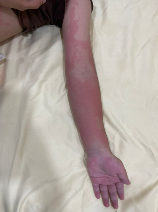 Dr_Aween_LiaNa's tweet photo. NOT ALL URTICARIA ARE FOOD ALLERGY

Hello orang ramai!

Ini adalah urticaria. Ia terrrrrsangatlah gatal. 

English layman term is hives. Melayu panggil gegata or kelopak garam. Ada juga patient sebut kat saya, ini ludah jin doctor. 😅😅

Ikuti threads utk tahu lebih lanjut. https://t.co/LMkGgLOCAj