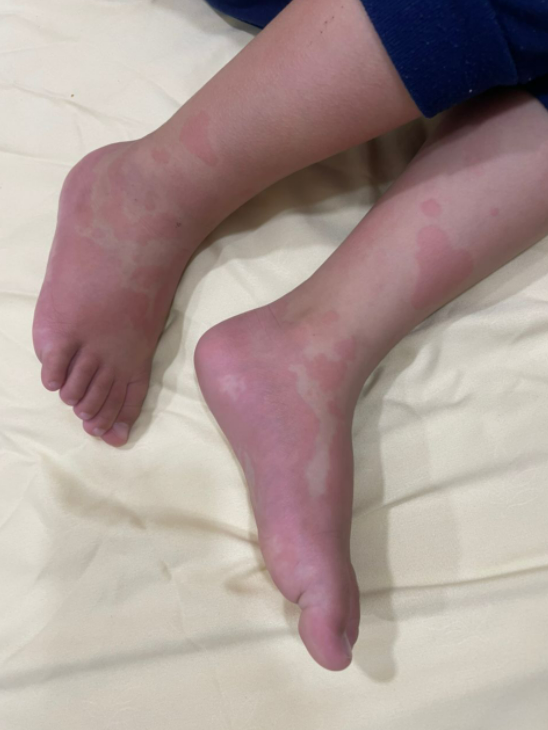 Dr_Aween_LiaNa's tweet photo. NOT ALL URTICARIA ARE FOOD ALLERGY

Hello orang ramai!

Ini adalah urticaria. Ia terrrrrsangatlah gatal. 

English layman term is hives. Melayu panggil gegata or kelopak garam. Ada juga patient sebut kat saya, ini ludah jin doctor. 😅😅

Ikuti threads utk tahu lebih lanjut. https://t.co/LMkGgLOCAj